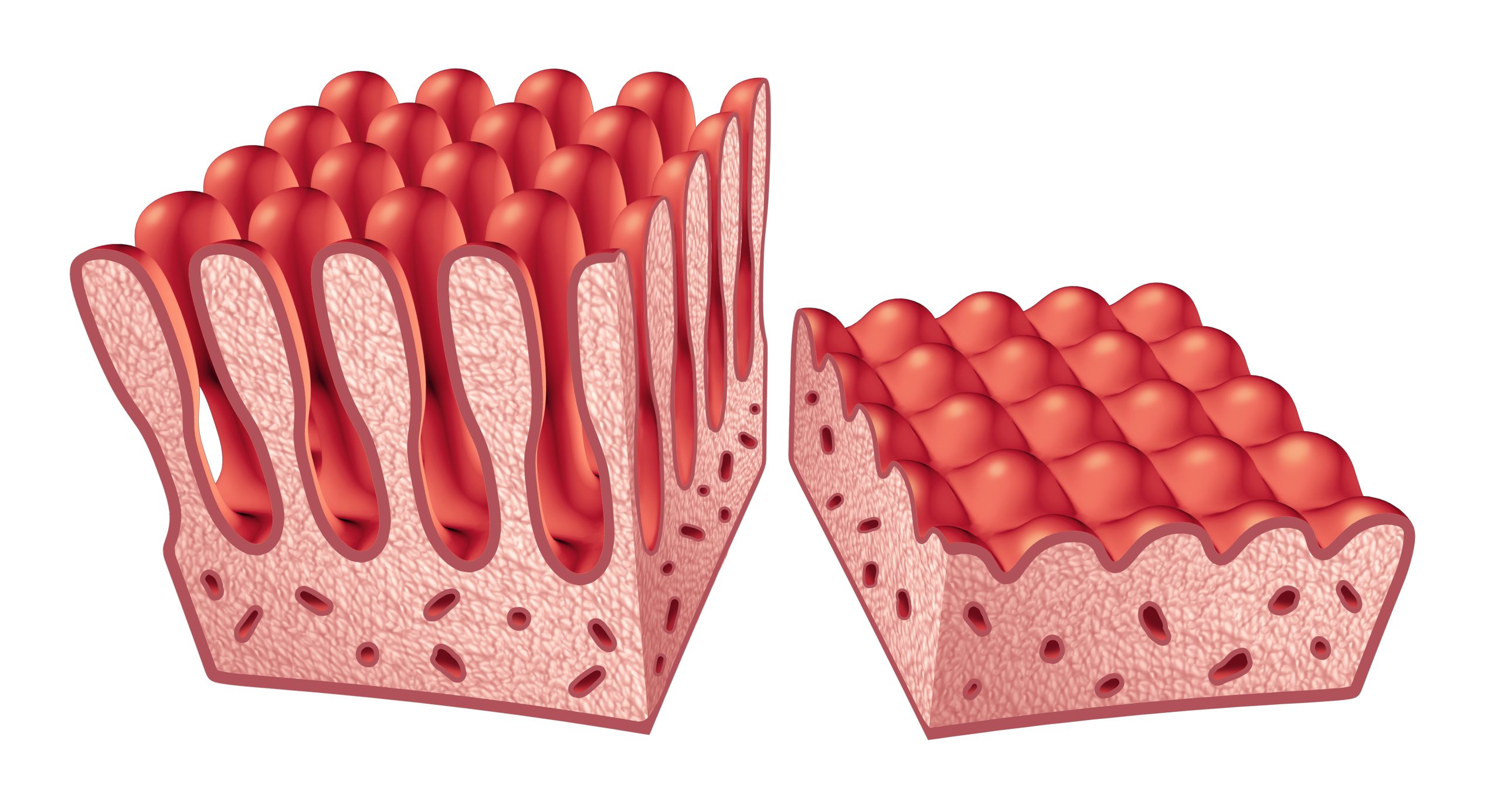A 3D illustration showing normal (healthy) villi on the left and damaged villi (coeliac disease) on the right.